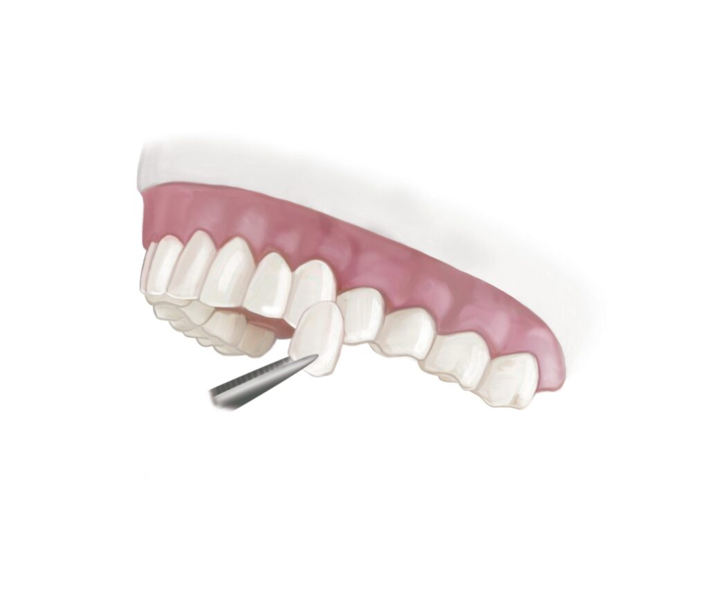 imgi 10 shutterstock 210687385 daniel berea Veneers