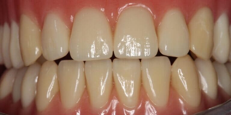 Feste Zähne auf nur vier Zahnimplantaten: All-on-4