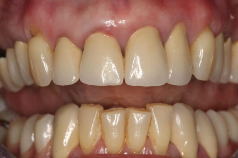 Ästhetisch und wirtschaftlich: Kombination aus festsitzendem und herausnehmbarem Zahnersatz