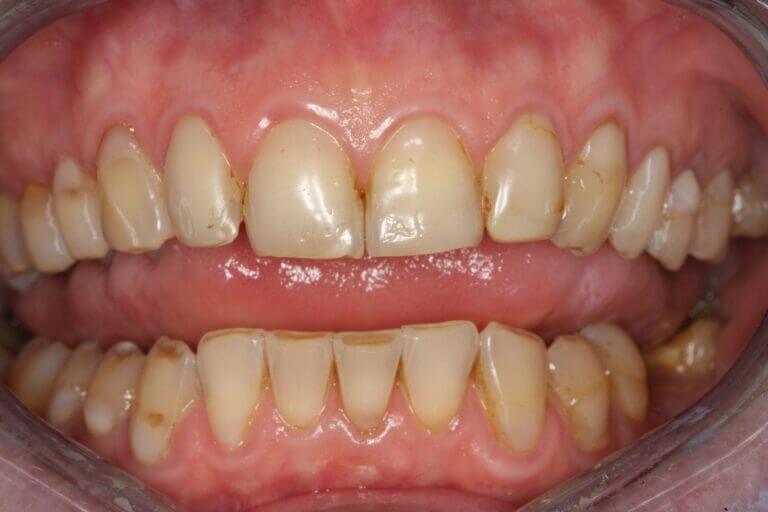 Abgenutzte Zähne – Interview mit Prof. Dr. Olze zum Thema Abrasionsgebiss