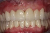 Bisshebung mit Vollkeramik – Schönes Lächeln trotz abgenutzter Zähne