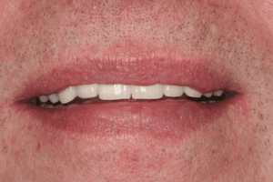 4-Quadrantensanierung 5 Offener Mund mit sichtbaren Zähnen