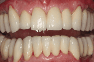 4-Quadrantensanierung 6 Gesunde Zähne, strahlendes Lächeln