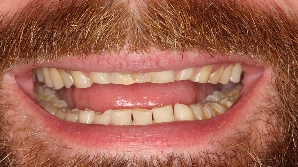 Bisshebung 4 OLZE Fachartikel Bisshebung Zahnhartsubstanz