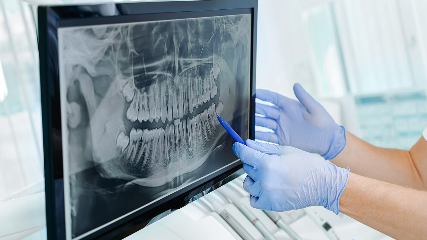 Implantate - trotz geschädigtem Kieferknochen 1 OLZE Fachartikel Implantat bei Knochendefizit HEader