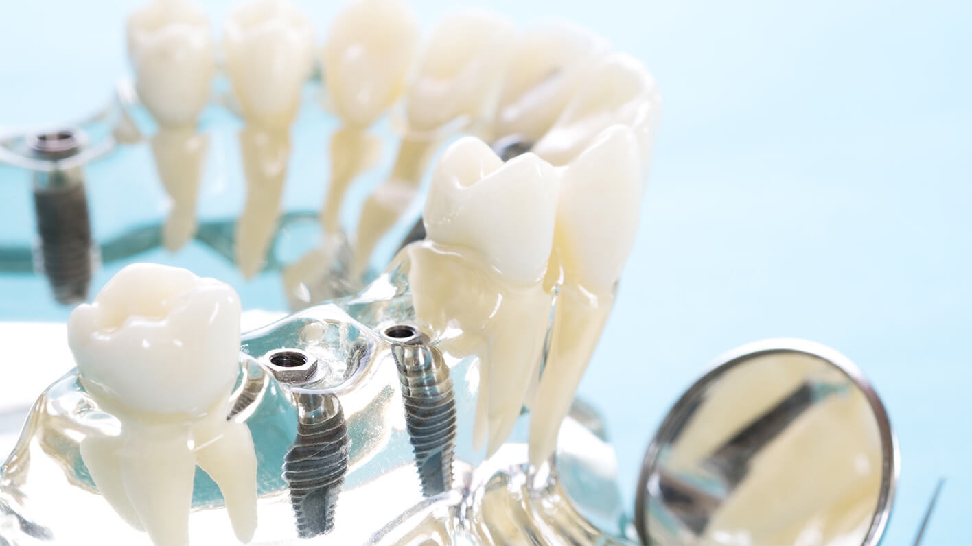 Implantatkomplexfall 1 OLZE Fachartikel Implantatkomplexfall Header 1