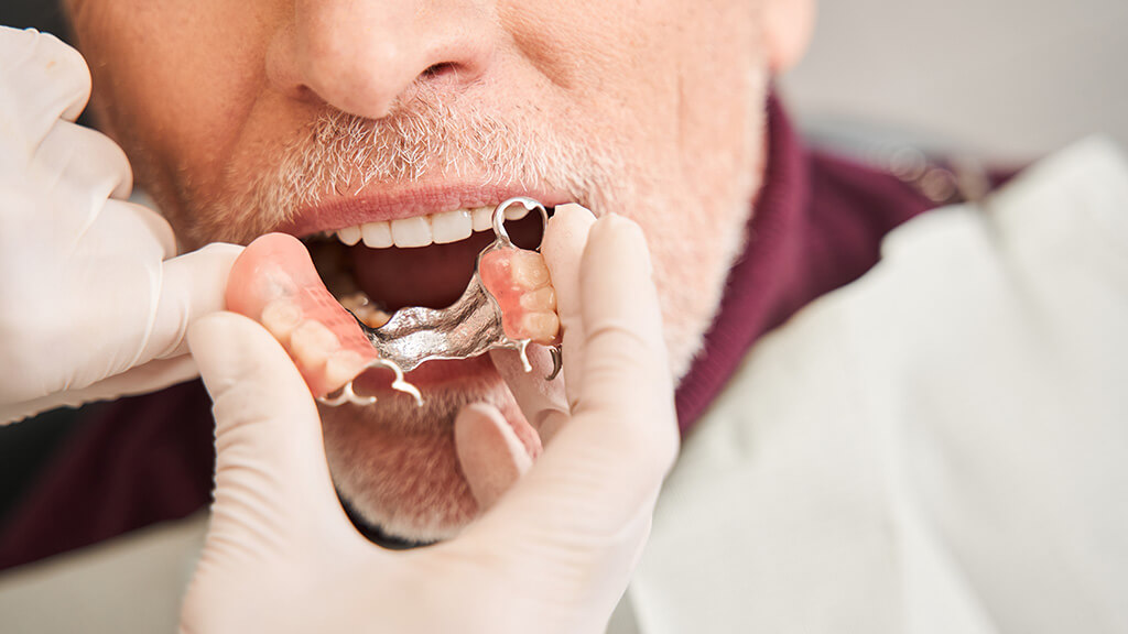 Zahnersatz - Ästhetisch und wirtschaftlich 4 OLZE Fachartikel Zahnersatz feste Verankerung