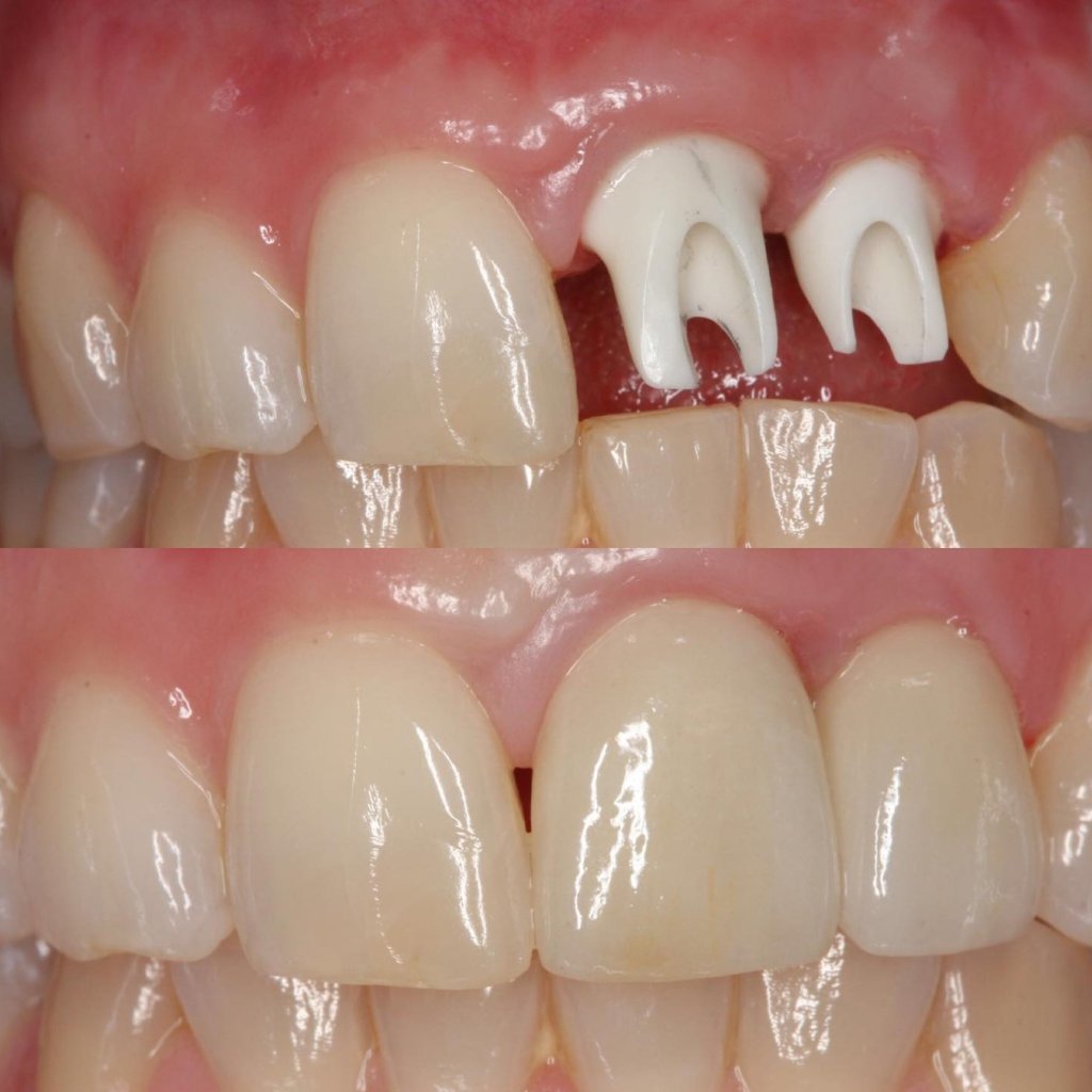 Implantate - trotz geschädigtem Kieferknochen 8 „Vorher-Nachher-Aufnahme einer Frontzahnimplantation mit individuellen Keramikabutments und fertigen keramischen Kronen im Oberkiefer.“