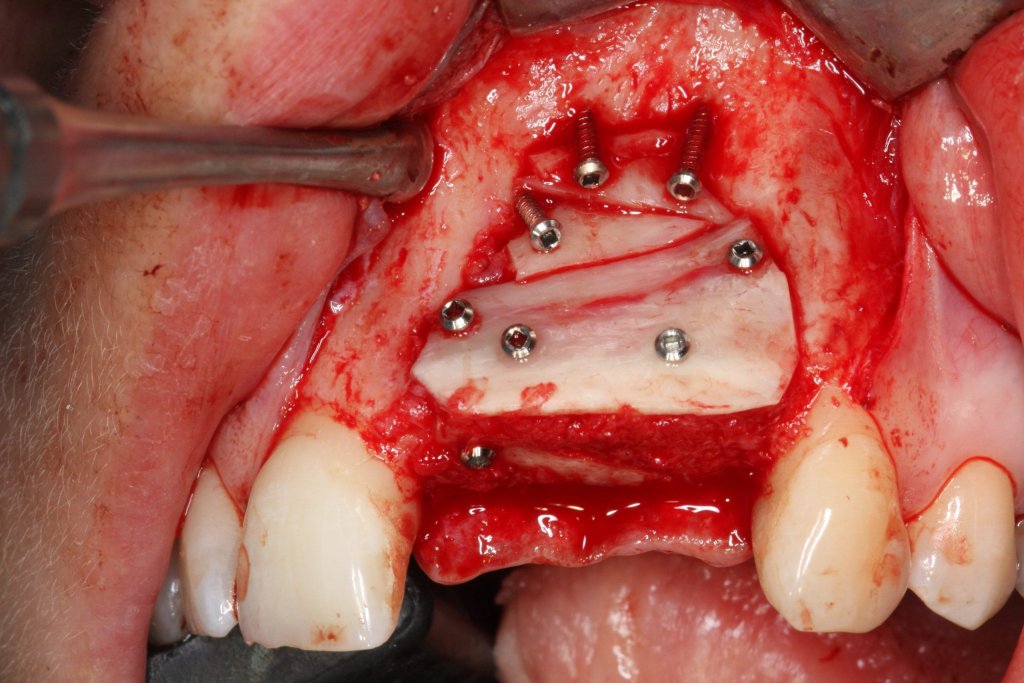 Implantate - trotz geschädigtem Kieferknochen 5 Intraorale Aufnahme einer Blockaugmentation im Oberkiefer-Frontzahnbereich mit fixiertem Knochenblock und eingesetzten Implantaten.