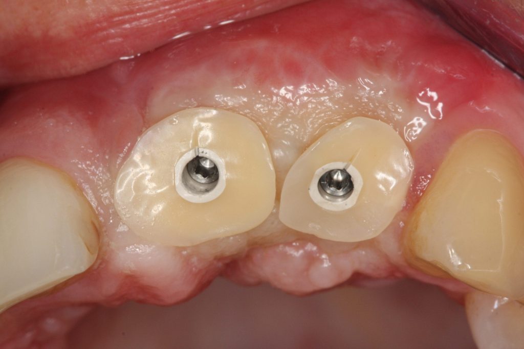 Implantate - trotz geschädigtem Kieferknochen 6 Zahnimplantate nach Knochenaufbau im Oberkiefer – Implantatbasis mit Einheilkappen in der Praxis Dr. Olze in Berlin-Mitte