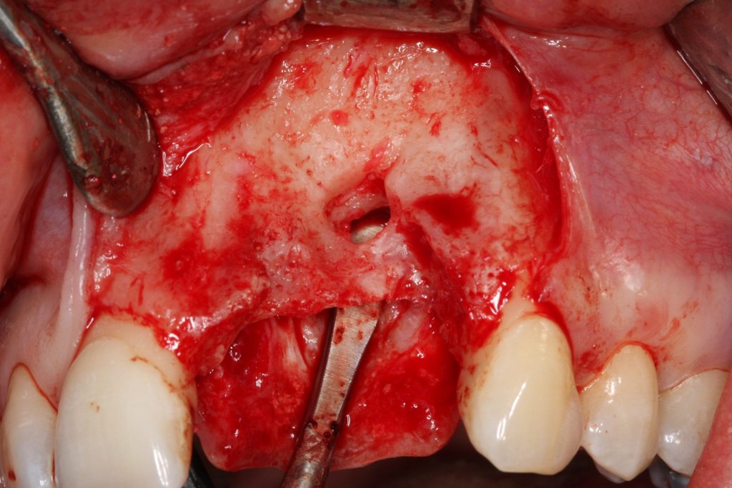 Implantate - trotz geschädigtem Kieferknochen 4 Intraorale Aufnahme eines großen Knochendefekts im Oberkiefer-Frontzahnbereich nach Freilegung und Vorbereitung zur Knochenaugmentation.