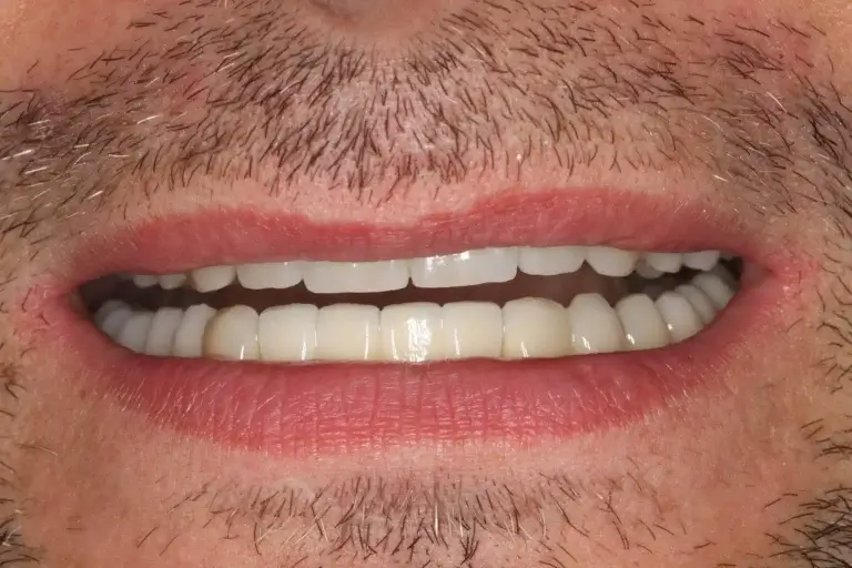 A Natural Smile After Receiving Implant-Supported Dental Prosthetics