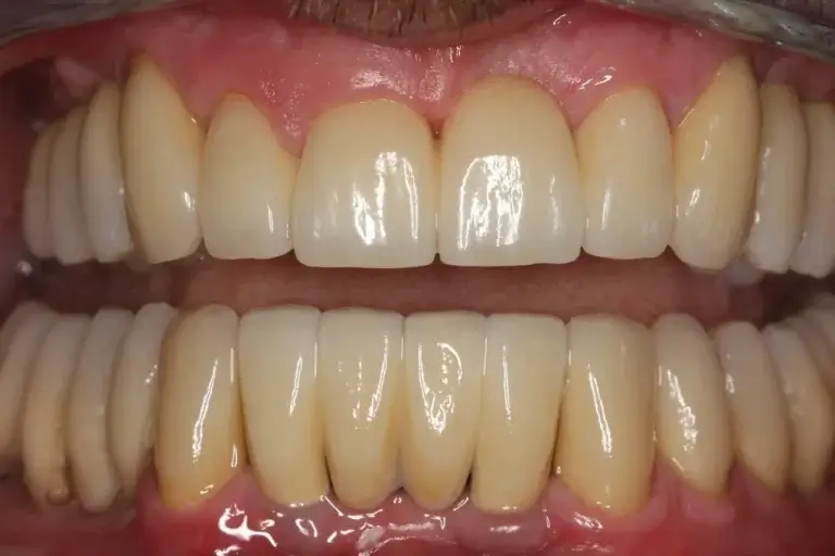 All-ceramic bridges and implant-supported dentures in the upper and lower jaws