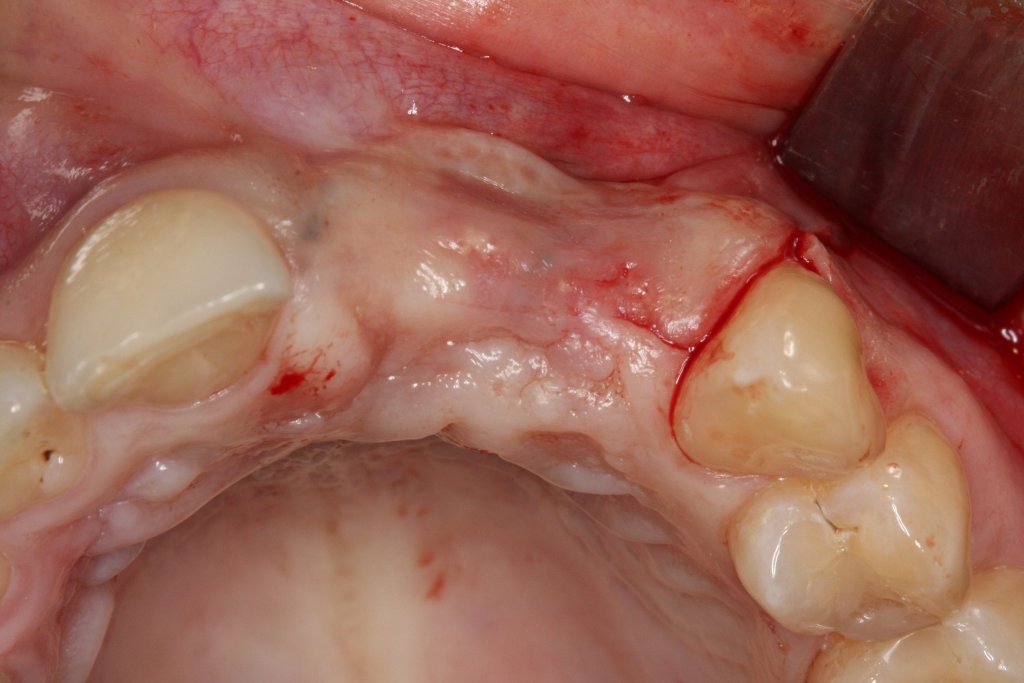 Implantate - trotz geschädigtem Kieferknochen 3 Klinische Aufnahme der Weichgewebssituation im Oberkiefer vor einer geplanten Knochenaugmentation im Frontzahnbereich.