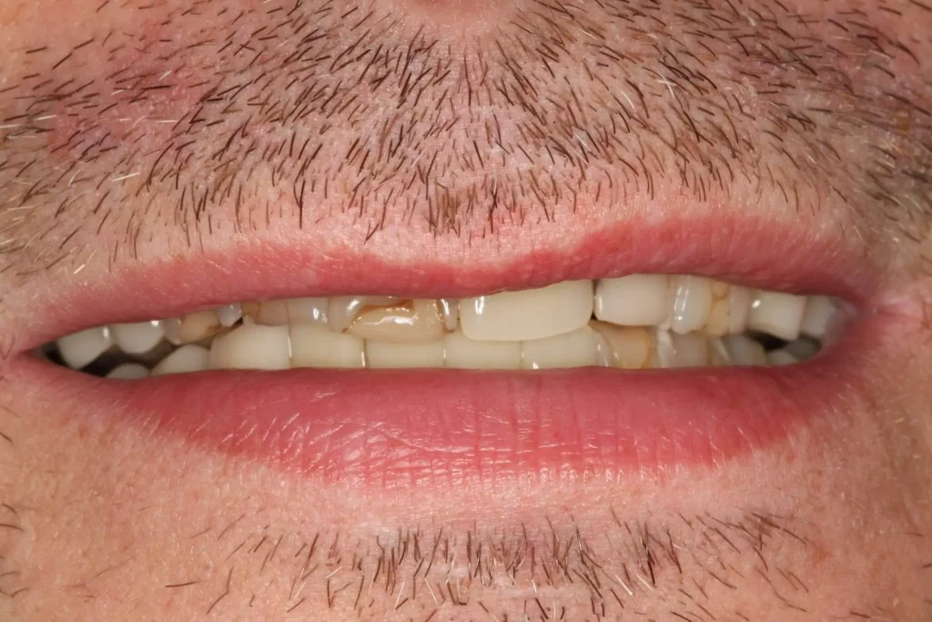 Close-up of a man's mouth showing a damaged dental bridge and visible fillings prior to dental treatment.
