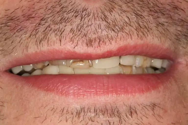Damaged front teeth and gaps between teeth prior to the custom-planned dental restoration