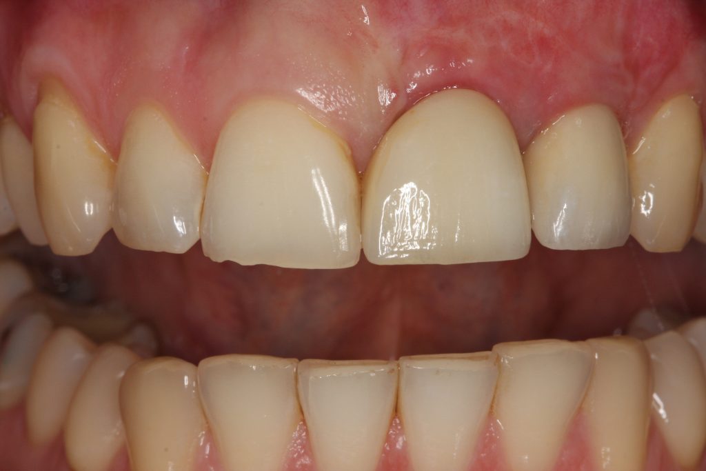 Implantate - trotz geschädigtem Kieferknochen 7 Festsitzender Zahnersatz nach Implantatbehandlung – ästhetisches Ergebnis in der Praxis Dr. Olze in Berlin-Mitte