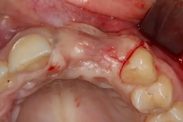 Geschädigter Kieferknochen – Vorbereitung des Knochenaufbaus Detailansicht einer zahnärztlichen Prozedur mit freigelegtem Zahnhals und umgebendem, leicht blutigem Zahnfleisch.