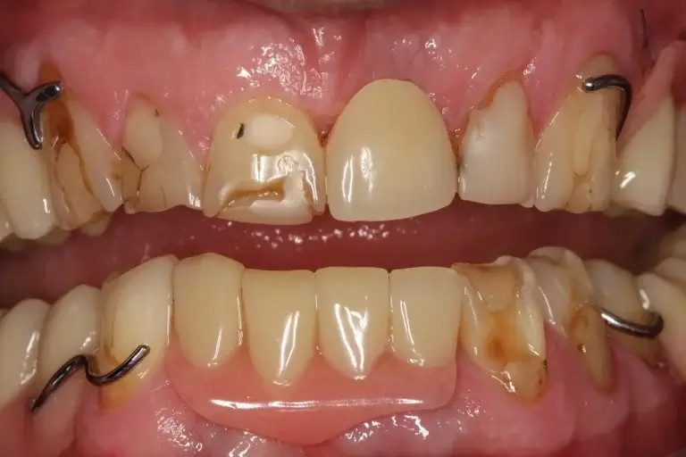 Damaged teeth and a removable temporary prosthesis prior to treatment with implants and fixed dental prostheses