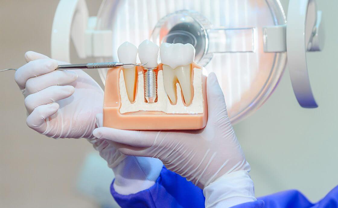 Zahnimplantate - Nachsorge 1 OLZE Fachartikel Zahnimplantate Nachsorge Header e1764155441467
