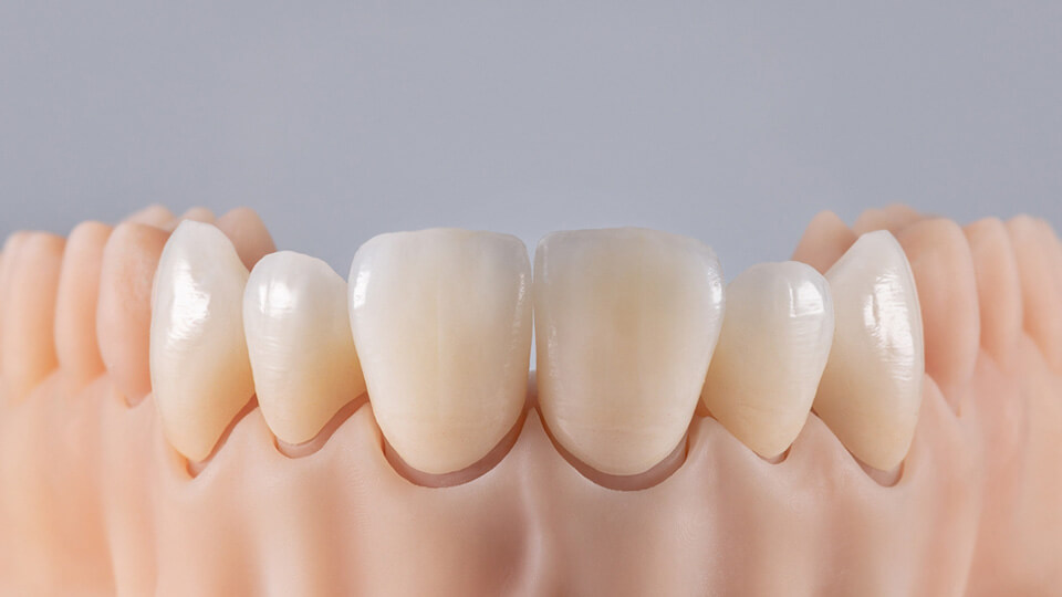 Frontzahnrekonstruktionen mit Keramiklösungen 1 OLZE Fachartikel Frontzahnrekonstruktionen 01