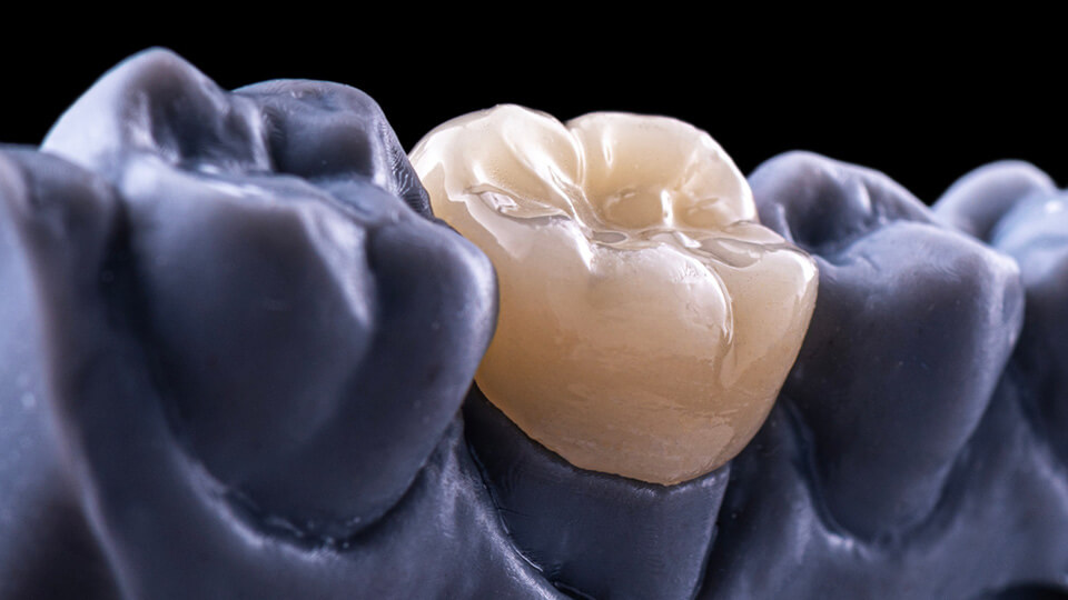 Frontzahnrekonstruktionen mit Keramiklösungen 4 OLZE Fachartikel Frontzahnrekonstruktionen 03