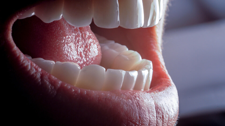 Frontzahnrekonstruktionen mit Keramiklösungen 5 OLZE Fachartikel Frontzahnrekonstruktionen 04