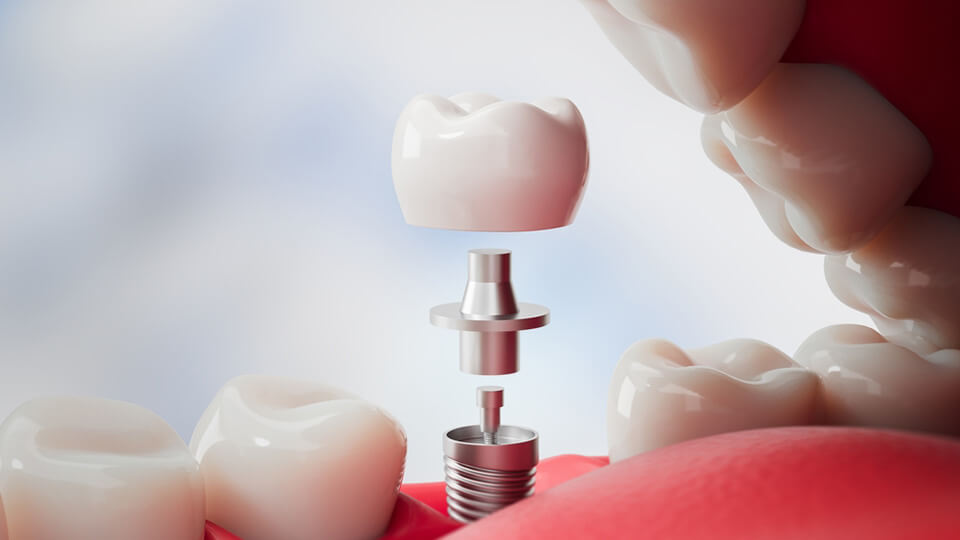 OLZE Fachartikel Implantatpfelge 02