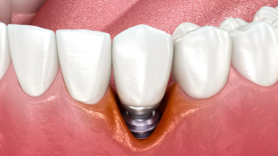 OLZE Fachartikel Implantatpfelge 03