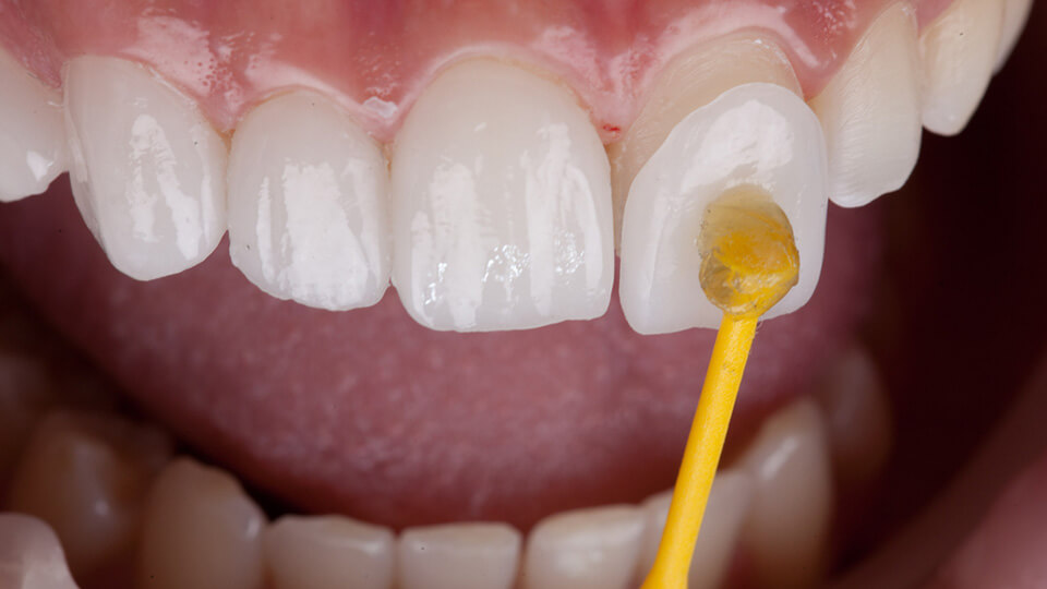 OLZE Fachartikel Minimalinvasive Veneers 02