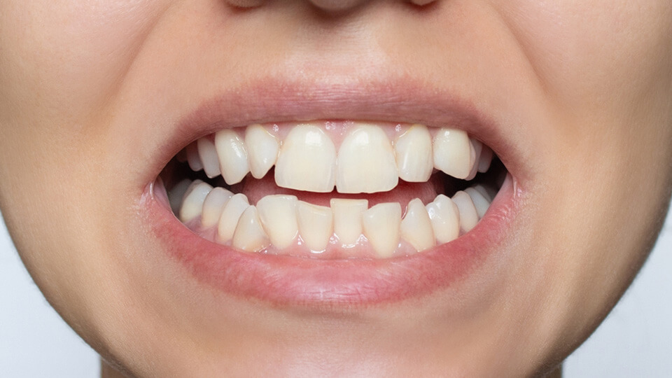 OLZE Fachartikel Minimalinvasive Veneers 04