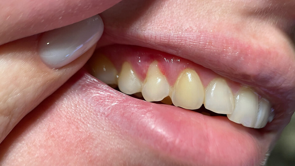 OLZE Fachartikel Schaedlicher Biofilm 02