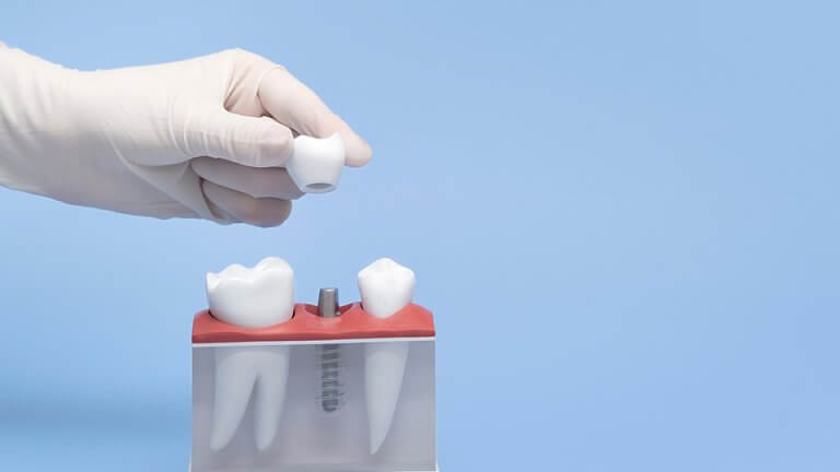 Modell zum Einsetzen ein Implantats