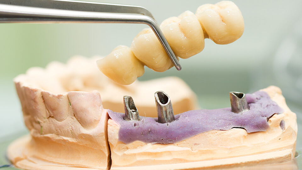 OLZE Fachartikel Zahnimplantate 02