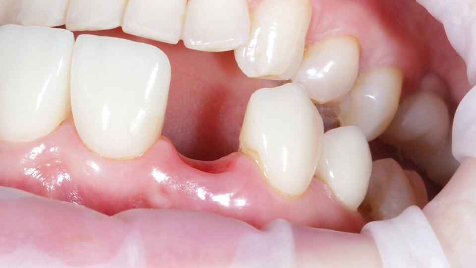 OLZE Fachartikel Zahnluecke schliessen 02