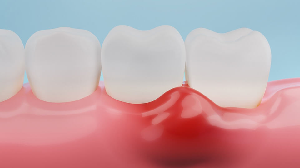 OLZE Fachartikel unbehandelter Parodontitis 02