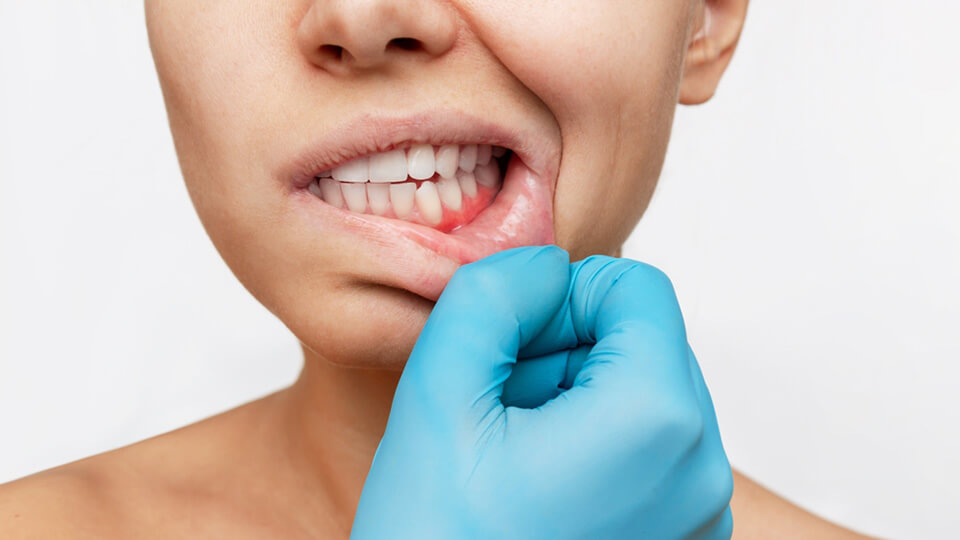 OLZE Fachartikel unbehandelter Parodontitis