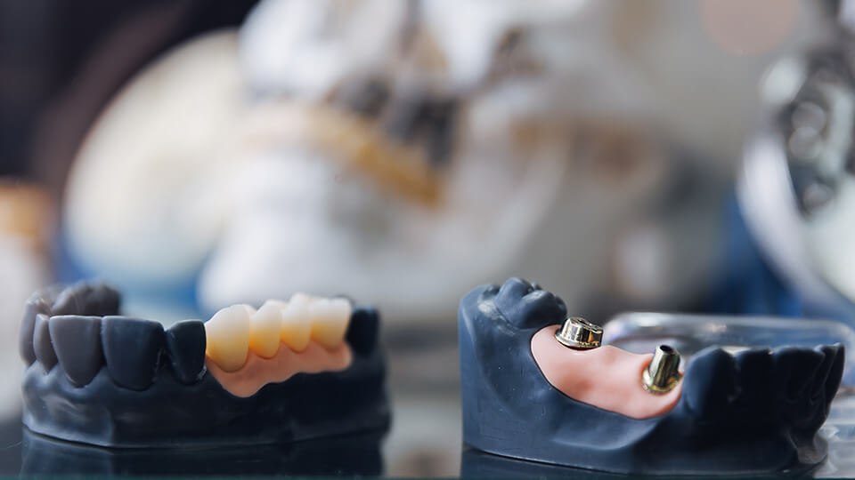 OLZE Fachartikel Zahnersatztypen 03