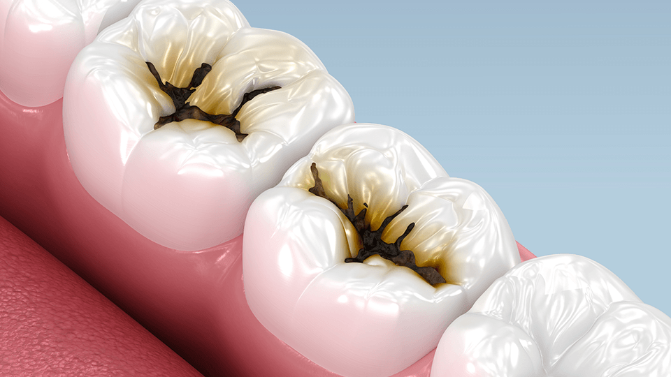 OLZE Fachartikel Zahnkrone 02