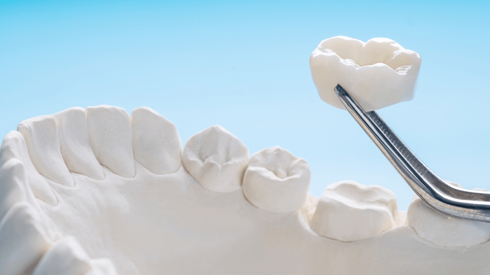 OLZE Fachartikel Zahnkrone 03