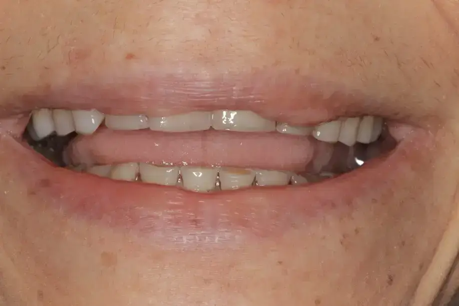 Zahnverschleiß – Ausgangssituation vor der Versorgung Worn teeth in the anterior region prior to all-ceramic restoration