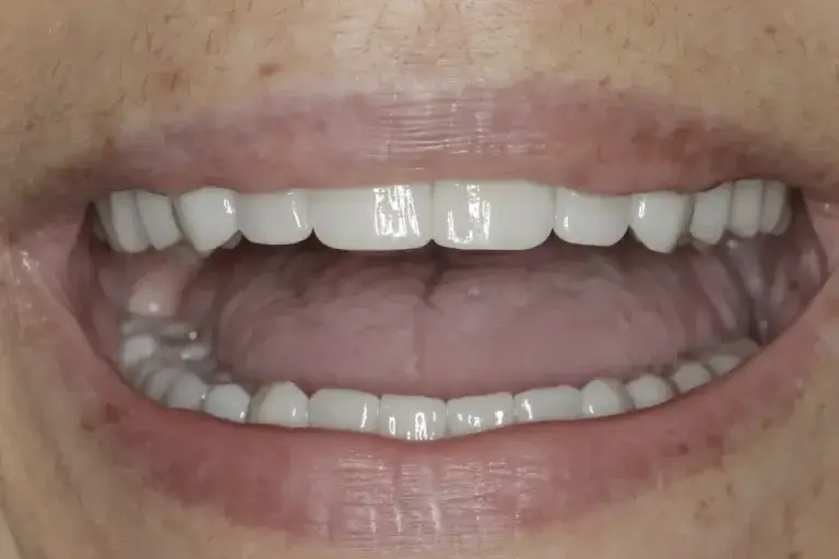 Vollkeramikversorgung – Behandlungsergebnis A harmonious set of teeth following comprehensive all-ceramic restoration