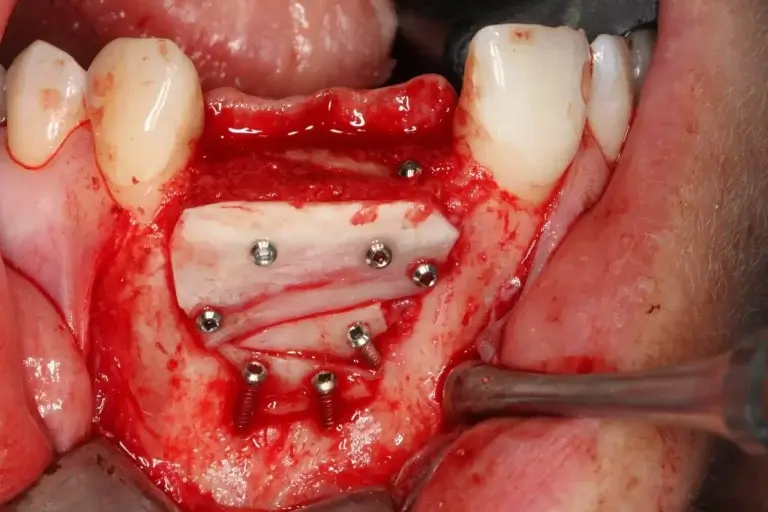 Geschädigter Kieferknochen – Knochenblockaugmentation Knochenblockaugmentation zur Vorbereitung einer stabilen Implantatversorgung im Frontzahnbereich